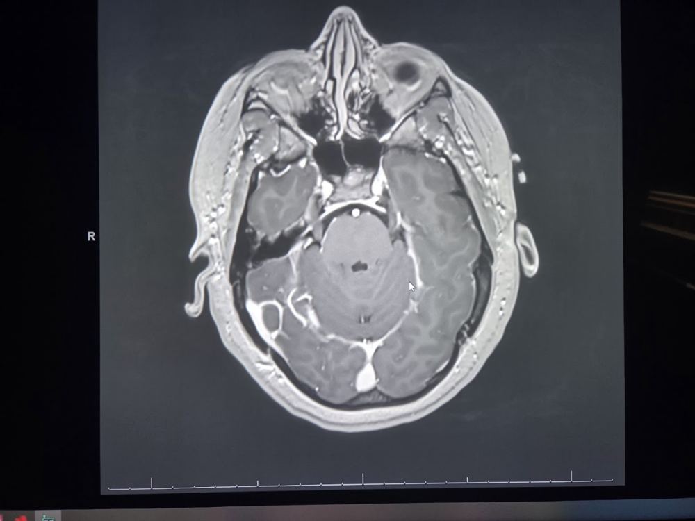 A black and white MRI scan of Logston's head seen from above